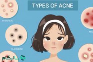 Types-of-pimples-and-acne